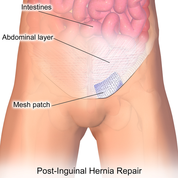 Surgery Tours Inguinal Hernia Surgery Causes Treatments And Risks