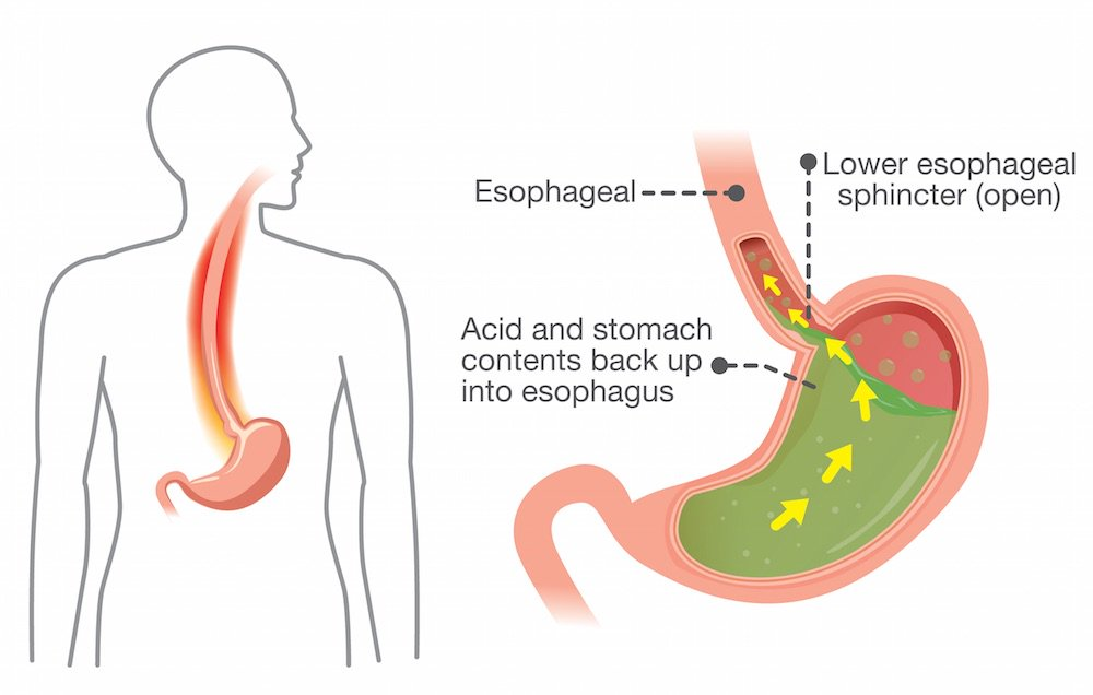 Gastroesophageal or Acid Reflux treatment SurgiCare